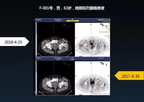 利用疟疾的疟原虫治疗癌症？靠谱吗？