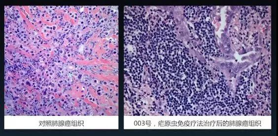 利用疟疾的疟原虫治疗癌症？靠谱吗？